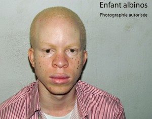 07-Enfant-albinos